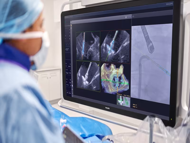 Philips’ DeviceGuide brings real-time AI navigation into structural heart valve repair